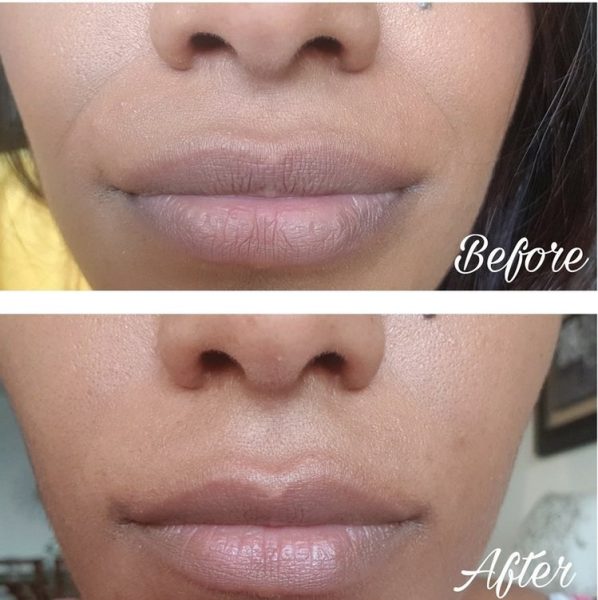 before-after-soraya